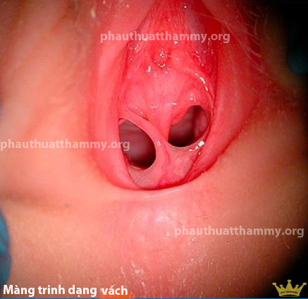 mang-trinh-dang-vach